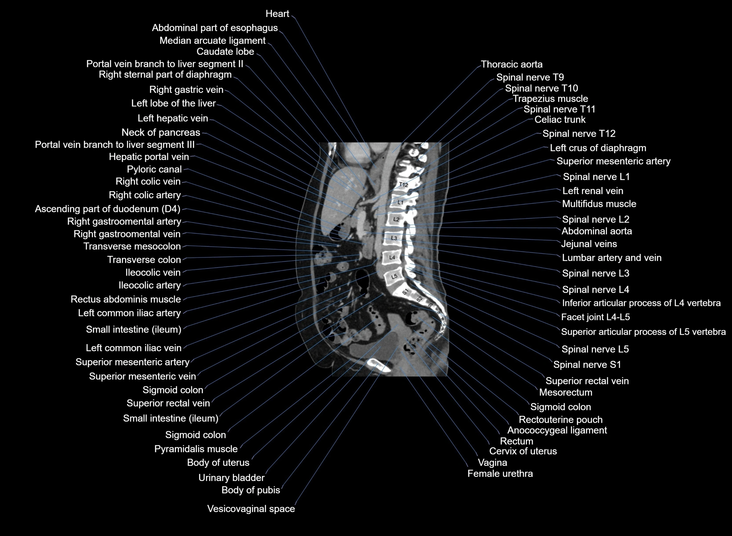 CT Abdomen sagittal cross sectional anatomy labelled radiology image -00058.webp